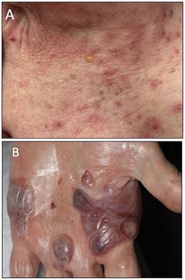 HLA inherence as a potential parameter in checkpoint inhibitor-associated autoimmune adverse event assessment